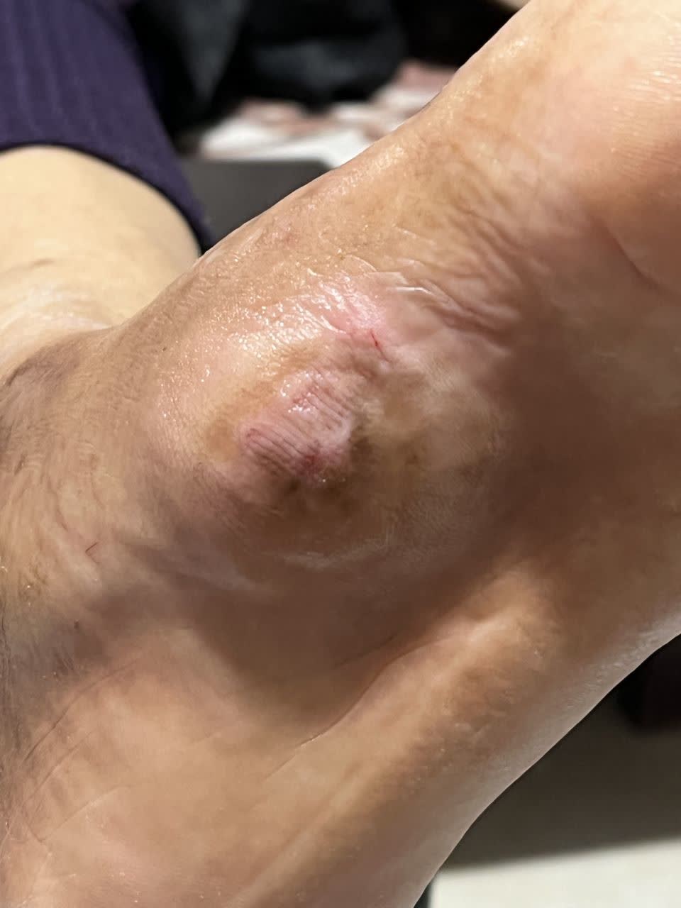 نتایج درمانی زخم بینش