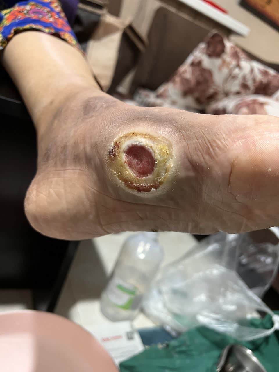 زخم پای دیابتی