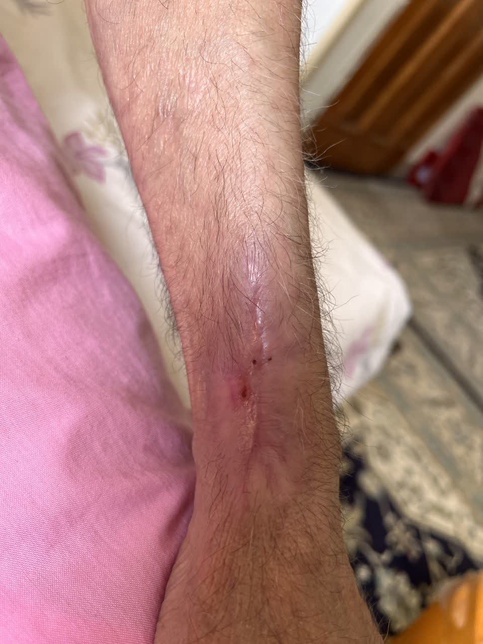 نتایج درمانی زخم بینش