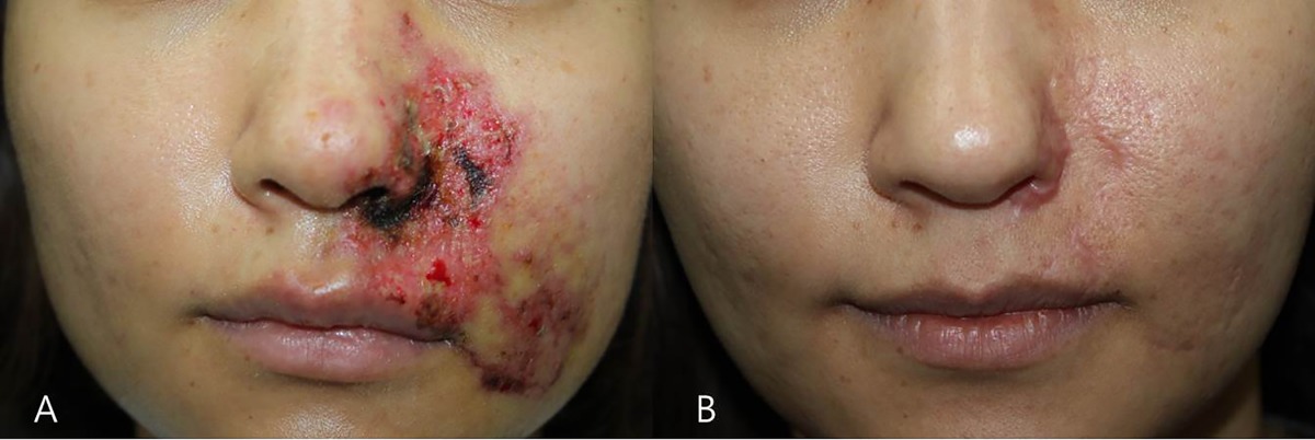 زخم و نکروز اعمال زیبایی